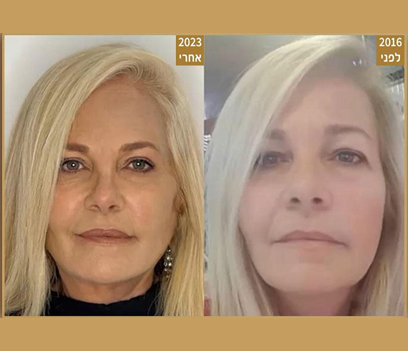 לפני-ואחרי-11